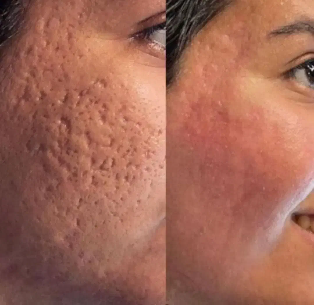 مزوتراپی ، PRP و مزونیدلینگ|خدمات آرایشگری و زیبایی|دوگنبدان, |دیوار