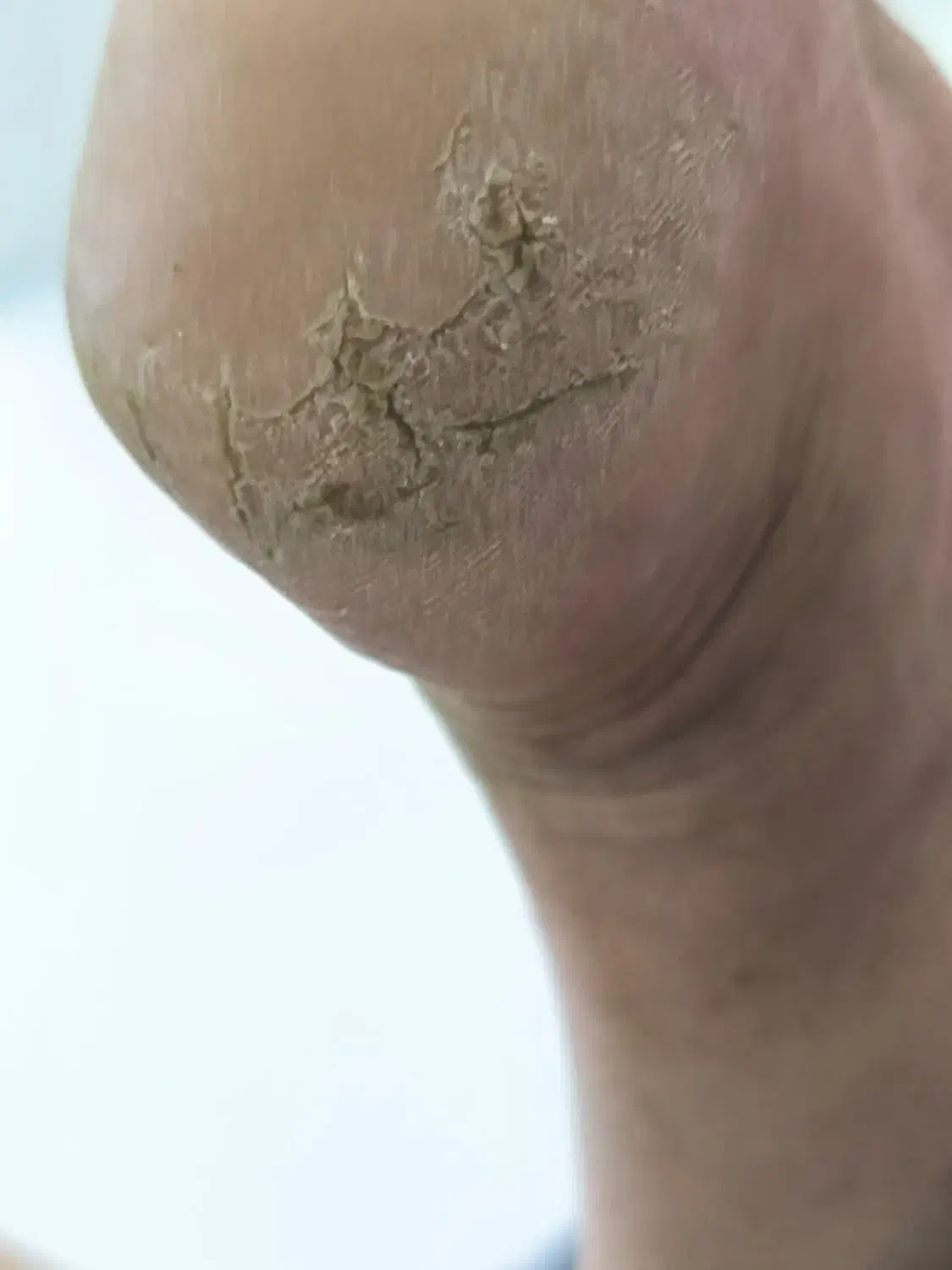 دوست داری ترک پاهات درمان بشه با یه قیمت منصفانه|خدمات آرایشگری و زیبایی|بندر انزلی, نوروزی|دیوار