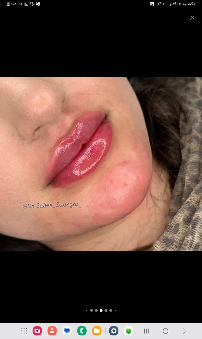 فیلر اقتصادی بوتاکس پیرسینگ|خدمات آرایشگری و زیبایی|ایرانشهر, |دیوار