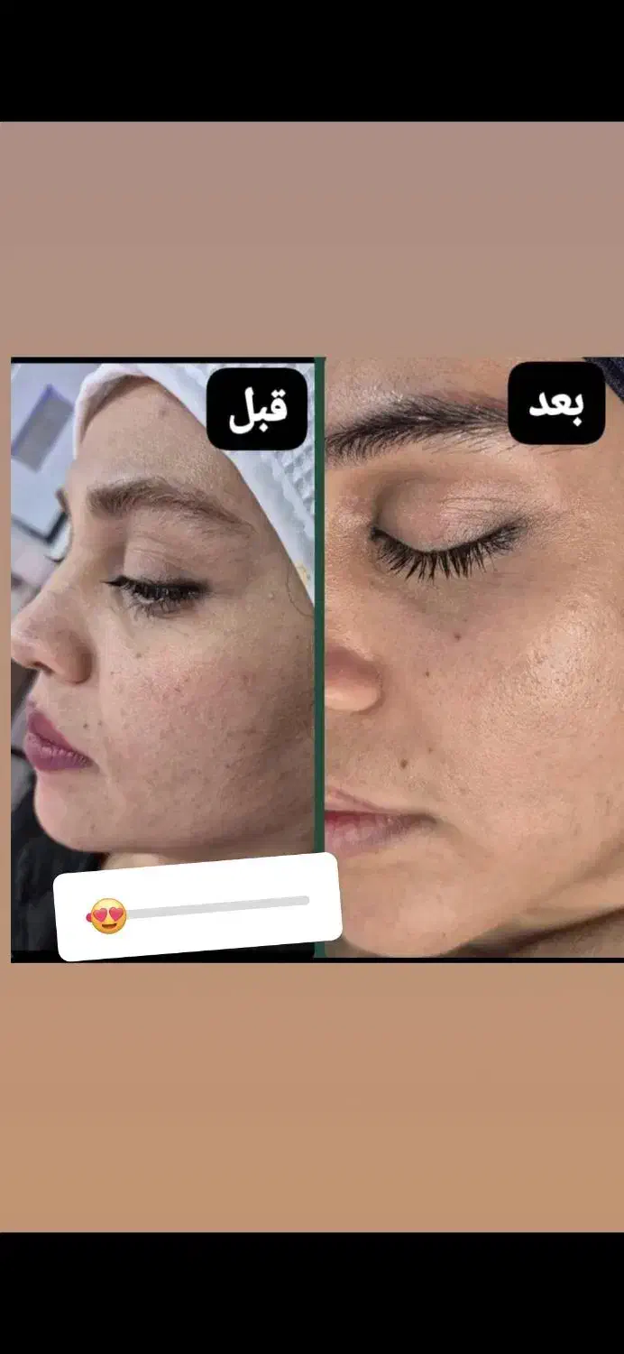فیشیال و پاک سازی درمانی ۵۰۰ تومان گلستان،سعدی|خدمات آرایشگری و زیبایی|اهواز, کوی سعدی|دیوار