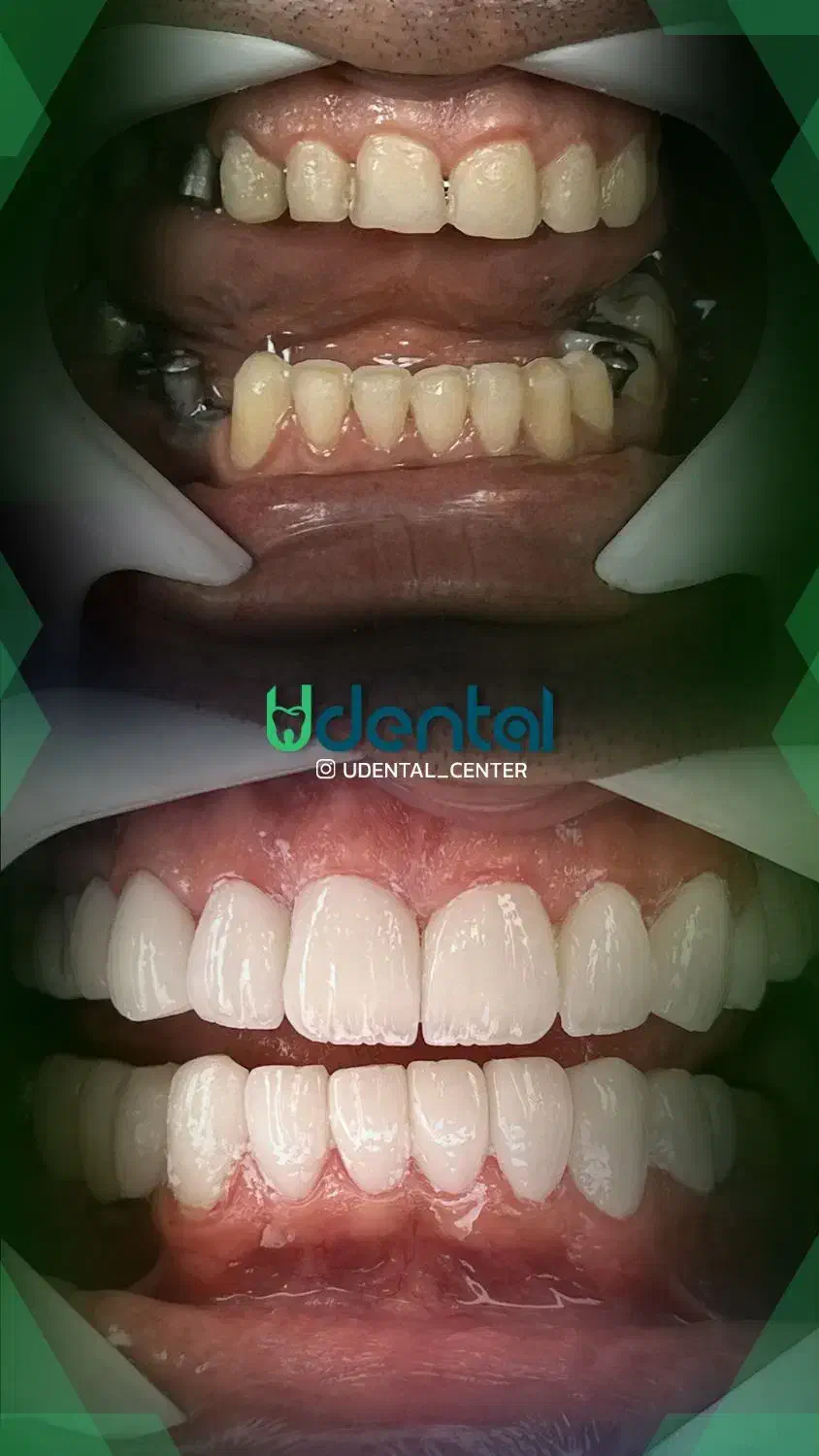 کاشت لبخند / کامپوزیت لمینیت|خدمات آرایشگری و زیبایی|تهران, قبا|دیوار