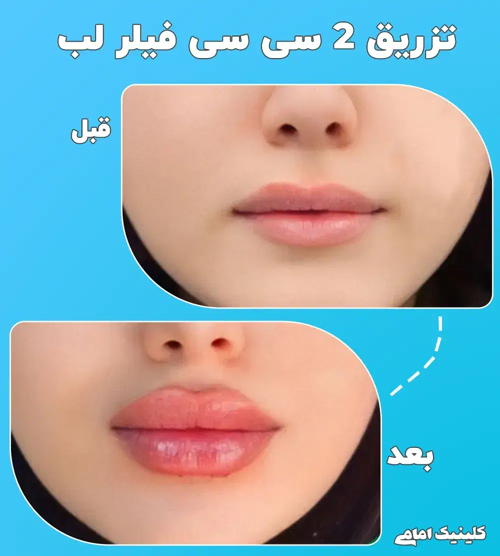 تزریق ژل و بوتاکس|خدمات آرایشگری و زیبایی|مشهد, تلگرد|دیوار