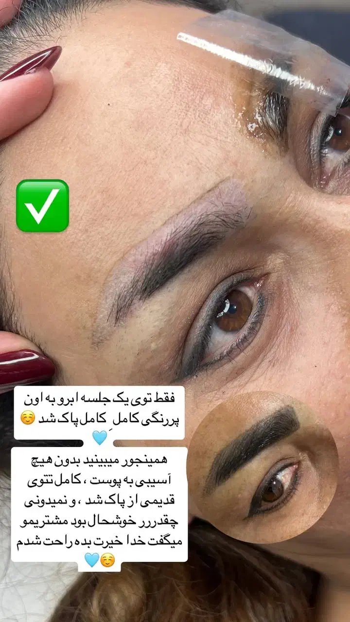 تخفیف ویژه ریموو (پاک کردن ابرو بمدت ۳روز|خدمات آرایشگری و زیبایی|جیرفت, |دیوار