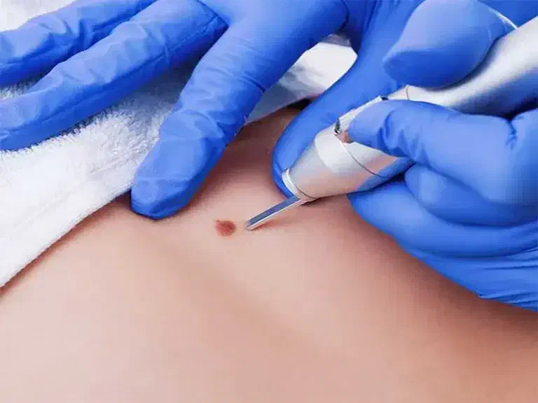 میکرو اسکالپ موی سر ،ریش، ابرو( در محل)|خدمات آرایشگری و زیبایی|تهران, سعادتآباد|دیوار