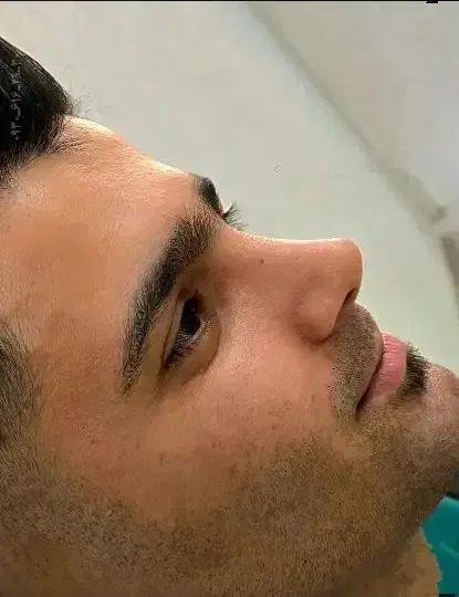 عمل بینی لیپوابدو لیفت غبغب دایرکت ابروتخفیف تهران|خدمات آرایشگری و زیبایی|قزوین, |دیوار