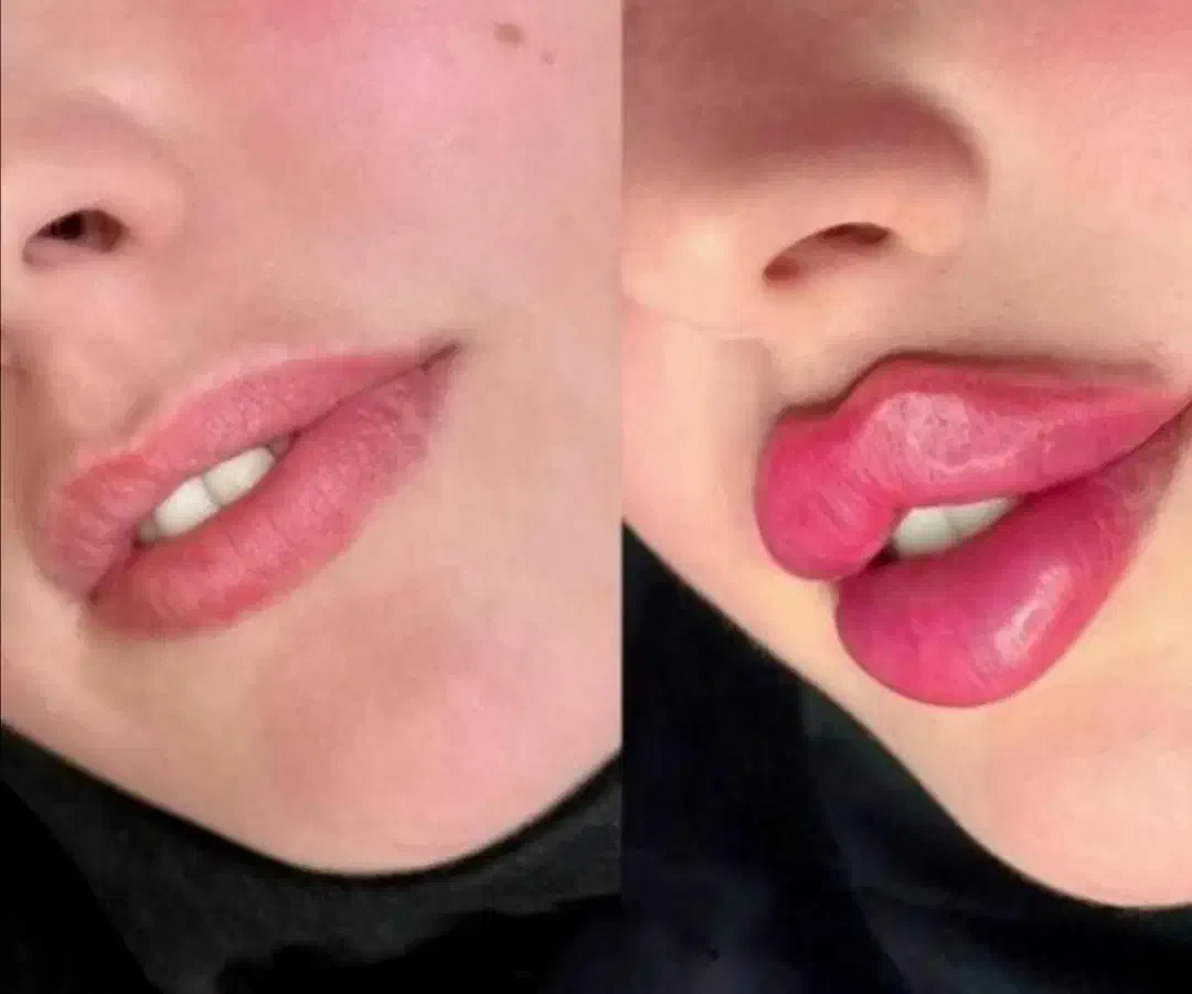 (کلینیک زیبایی) فیلر،بوتاکس مزوژل جوانساز، ضدلک|خدمات آرایشگری و زیبایی|قشم, |دیوار