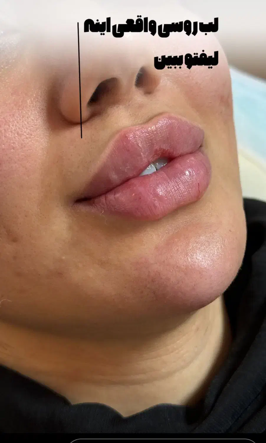 تزریق ژل بوتاکس فیلر لیزرجوانساز مزو مطب زیبایی|خدمات آرایشگری و زیبایی|تبریز, |دیوار