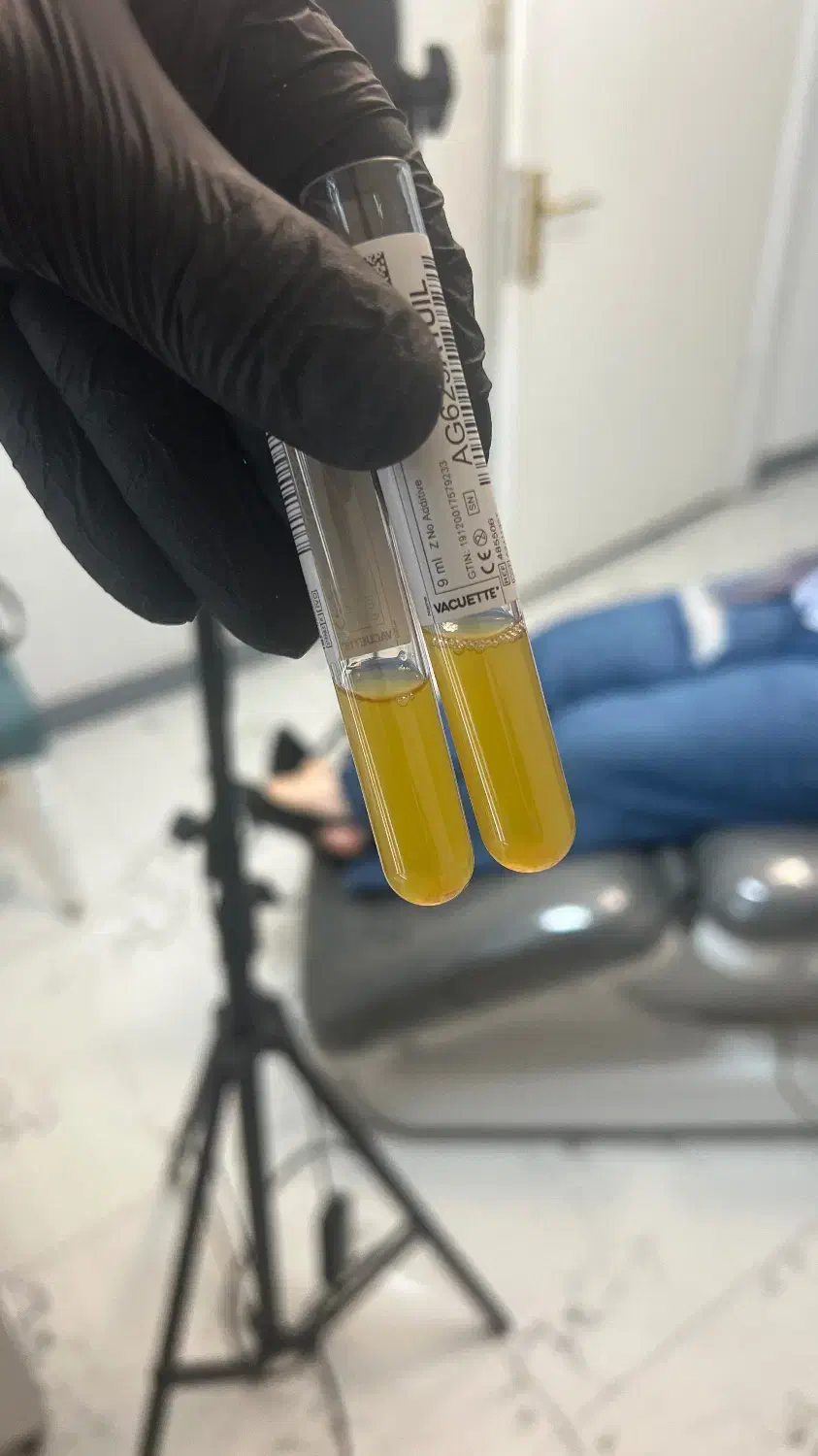 پی ار پی برای جوانسازی صورت، قطع ریزش مو، prp رشت|خدمات آرایشگری و زیبایی|رشت, گلسار|دیوار