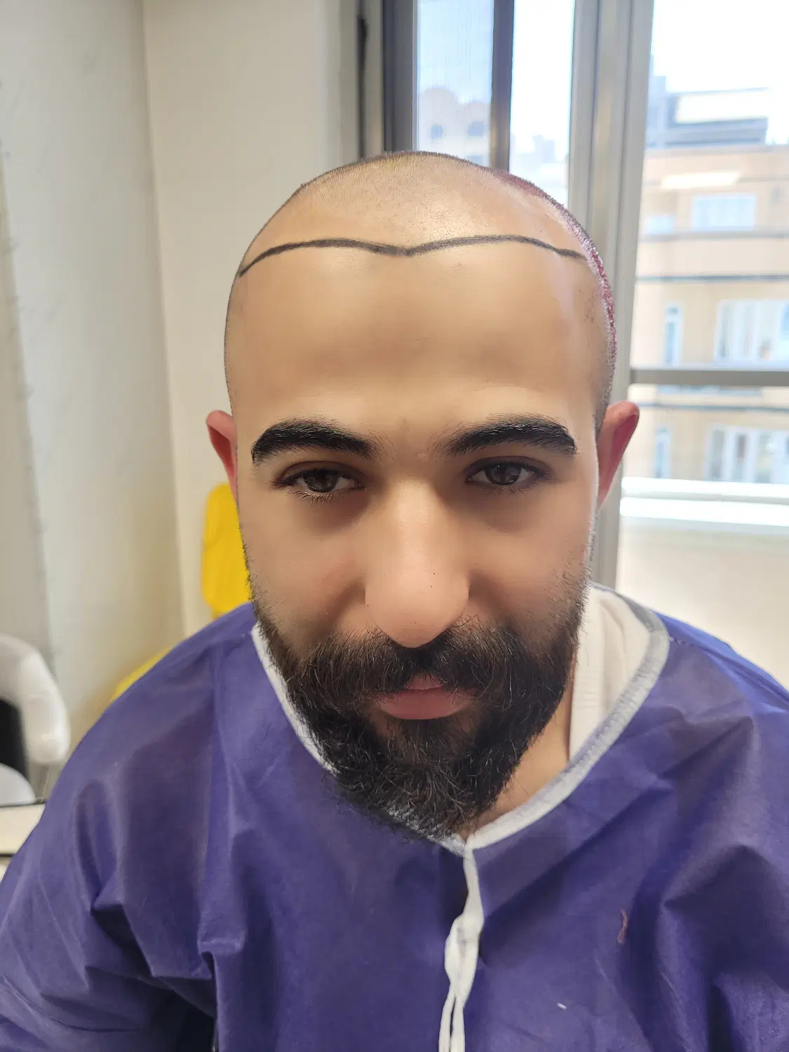 مزوتراپی/درمان ریزش موقطعی|خدمات زیبایی و سلامت|تبریز, |دیوار
