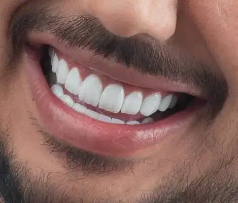 کامپوزیت دندان|خدمات آرایشگری و زیبایی|بروجرد, |دیوار