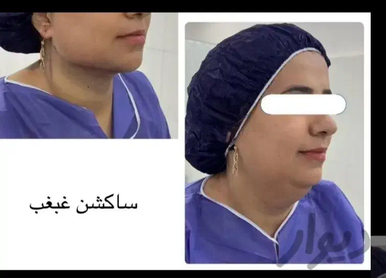 ساکشن شکم پهلو کمر غبغب و تزریق به باسن|خدمات آرایشگری و زیبایی|اهواز, نادری|دیوار