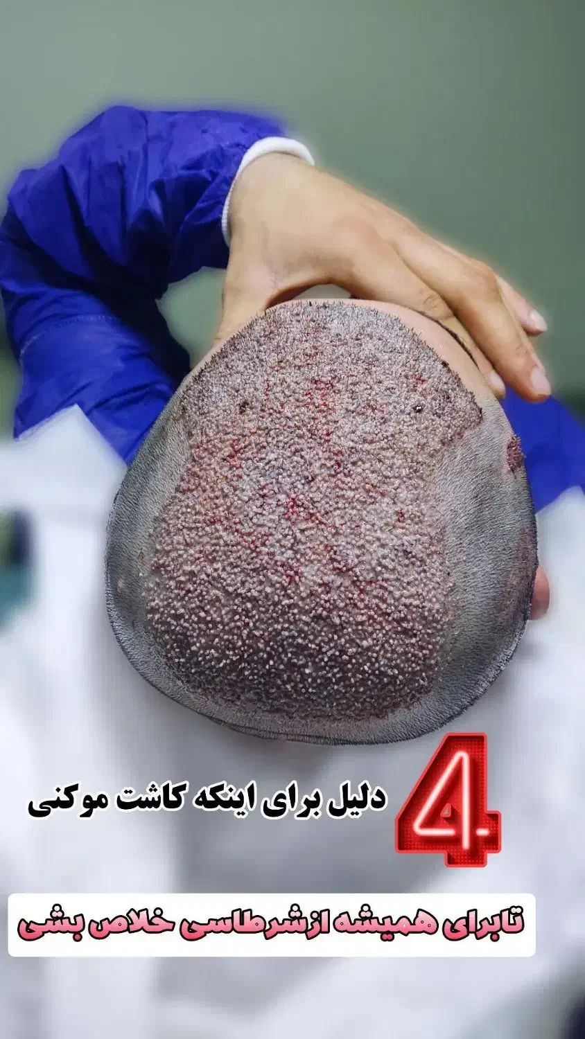 کاشت موی طبیعی|خدمات آرایشگری و زیبایی|شیراز, قدوسی شرقی|دیوار