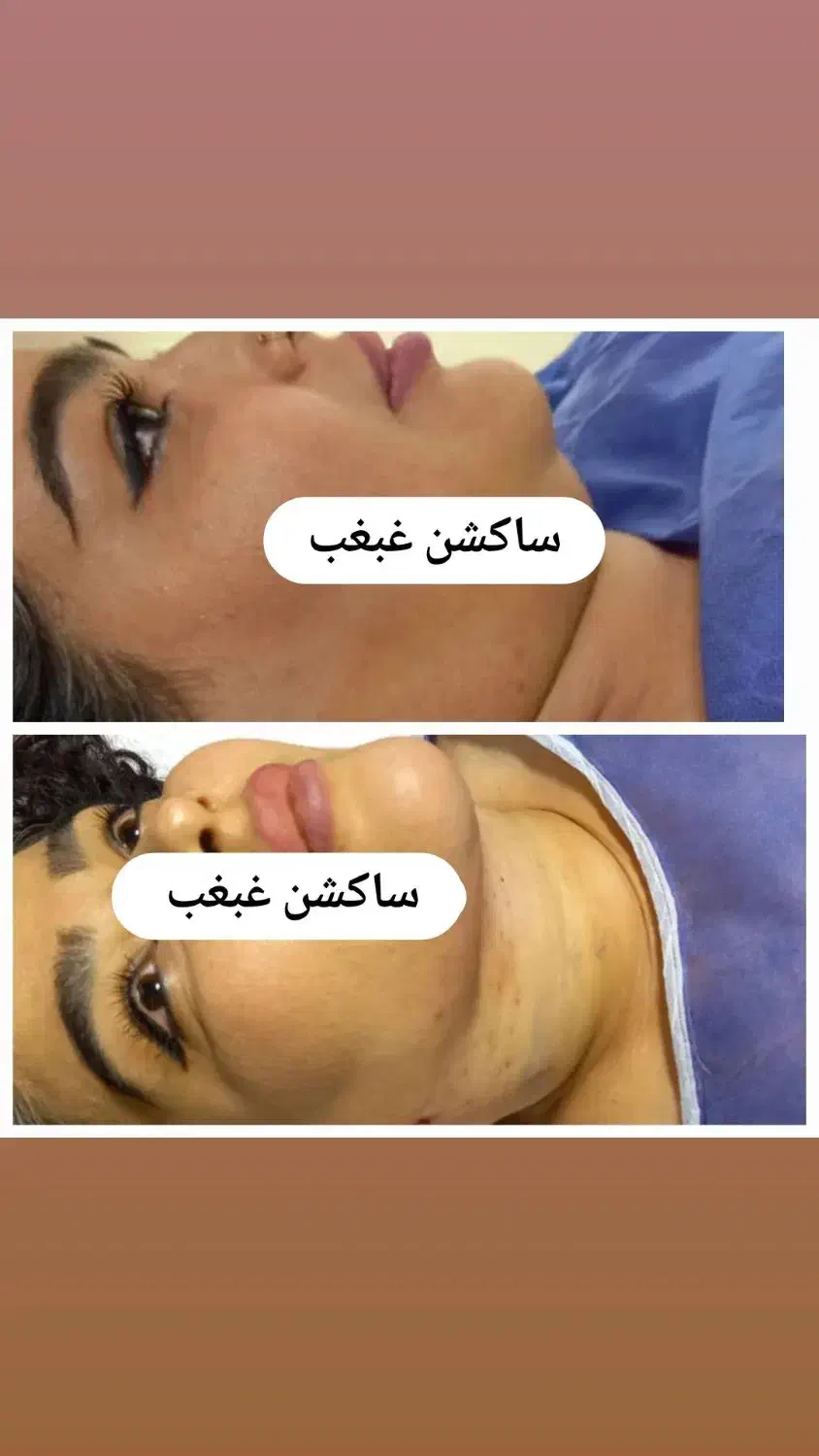 ساکشن غبغب تزریق چربی ۲م فقط پنجشنبه و جمعه|خدمات آرایشگری و زیبایی|اهواز, امانیه|دیوار