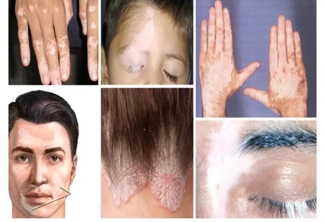 پیسی وویتیلیگو|آرایشی، بهداشتی، درمانی|تیکمه داش, |دیوار