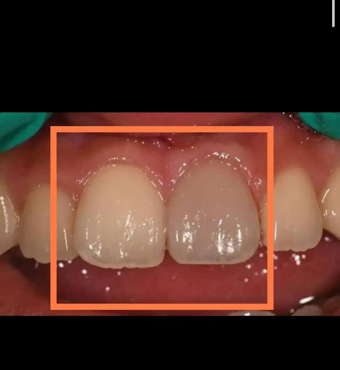 عصبکشی اندو دندان جلو۱۲۳تعرفه دولتی|خدمات آرایشگری و زیبایی|قم, زنبیل آباد|دیوار