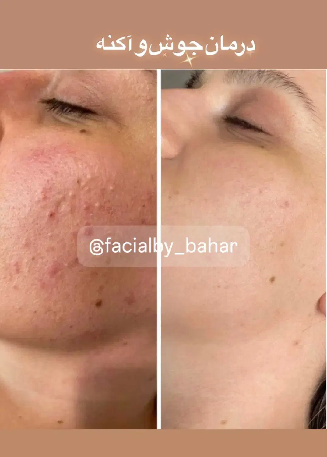 مزونیدلینگ حرفه‌ای در کلینیک زیبایی/هاشمیه|خدمات آرایشگری و زیبایی|مشهد, چهارچشمه|دیوار