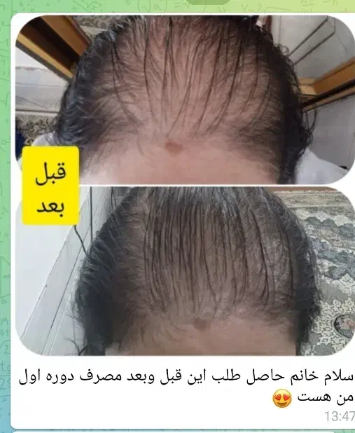 پک ریزش مو برای اولین بار در ایران|آرایشی، بهداشتی، درمانی|قم, چهار مردان|دیوار