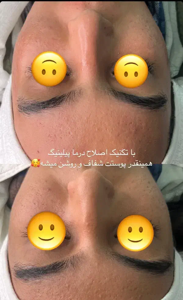 درماپلنینگ تخصصی صورت|خدمات آرایشگری و زیبایی|زابل, |دیوار