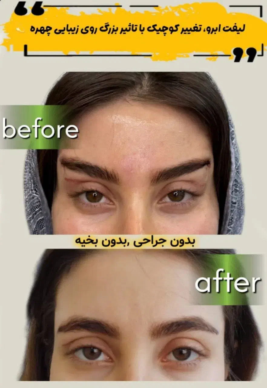 مرکز تخصصی تزریق فول فیس چربی و فیلر/لیفت با نخ|خدمات آرایشگری و زیبایی|مشهد, هنرستان|دیوار