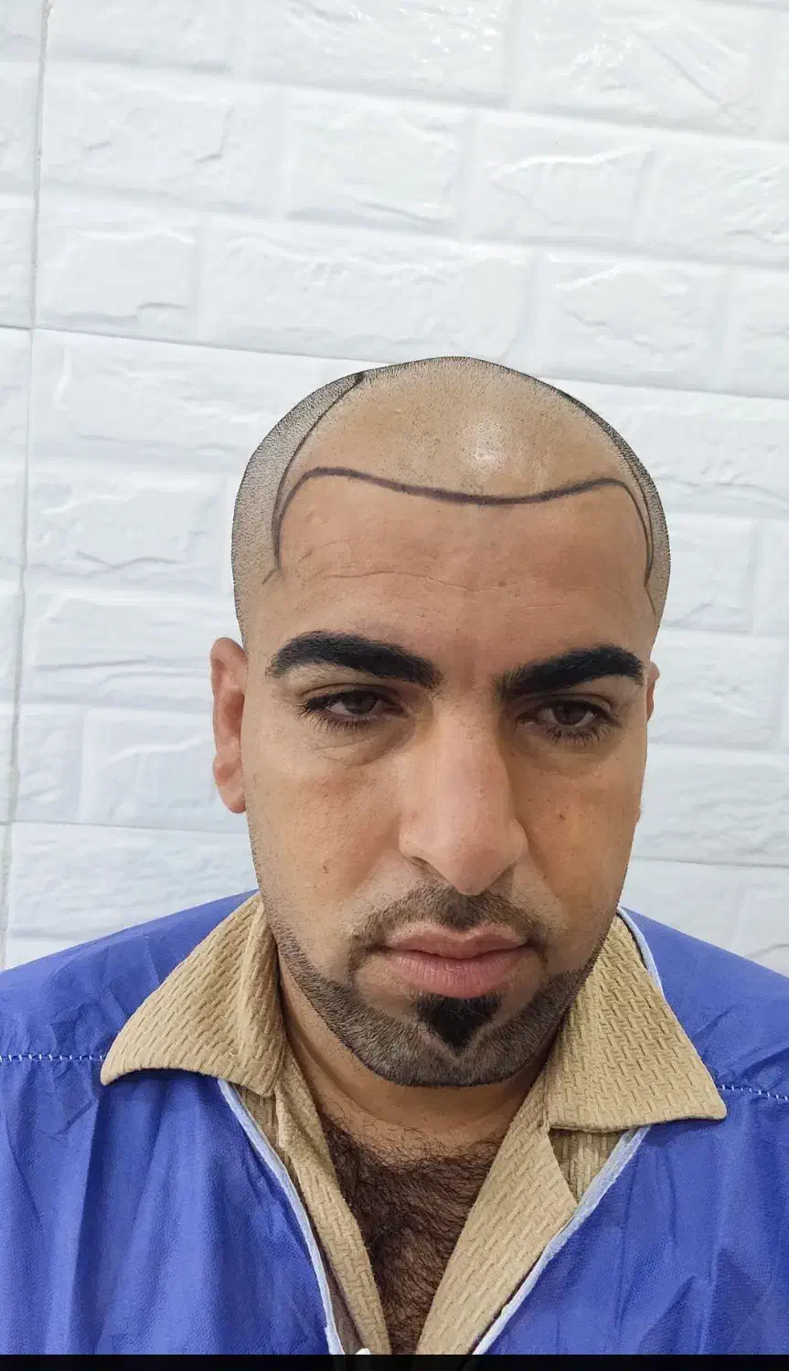 کاشت مو طبیعی به روش سوپر میکروگرفت|خدمات آرایشگری و زیبایی|اهواز, کیانپارس |دیوار