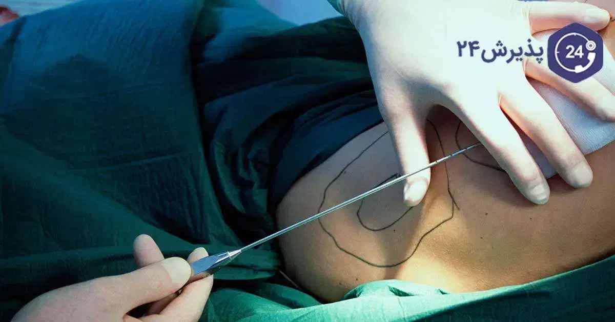 لیپوساکشن،غبغب پیکرتراشی و تزریق  اقساطی توسط پزشک|خدمات آرایشگری و زیبایی|تبریز, |دیوار