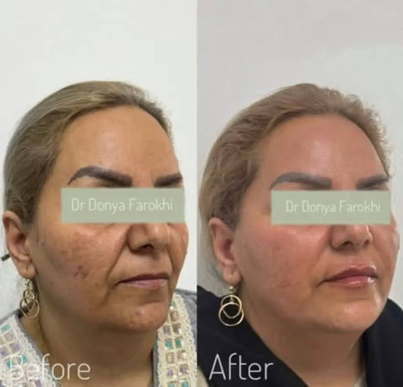 ژل بوتاکس لیزر لاغری مشاوره رایگان مطب دکتر فرخی|خدمات آرایشگری و زیبایی|اسلامآباد غرب, |دیوار