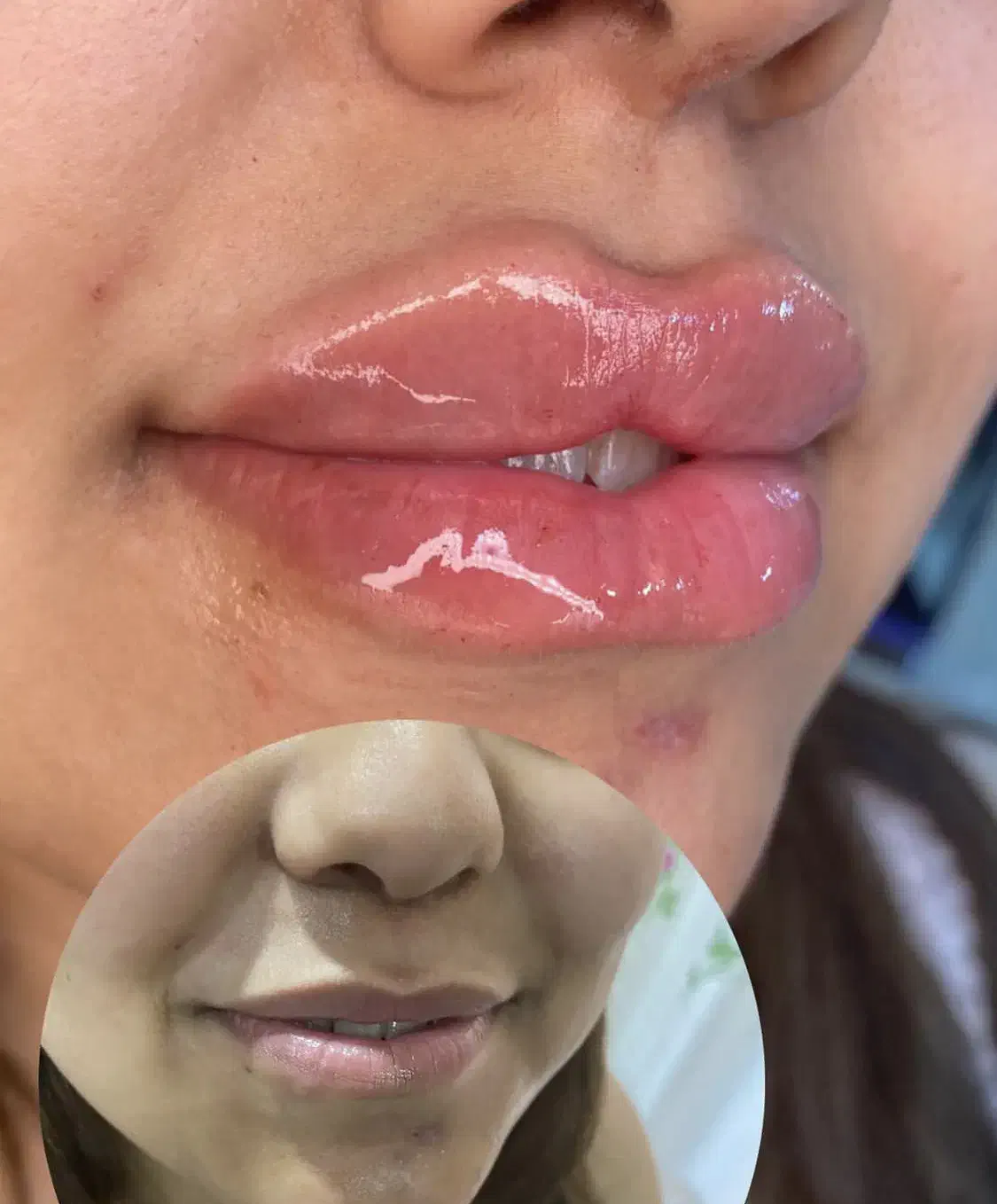 ژل و بوتاکس|خدمات آرایشگری و زیبایی|شوشتر, |دیوار