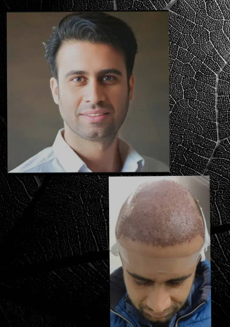 کاشت مو.ابرو.ریش.فول تراکم با شرایط استثنایی|خدمات آرایشگری و زیبایی|شیراز, ستارخان|دیوار