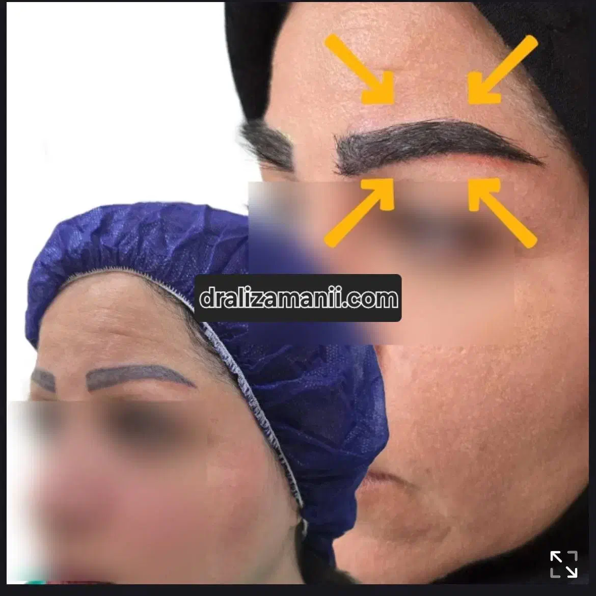 بلفاروپلاستی کاشت ابرو کاشت مو تخفیف|خدمات آرایشگری و زیبایی|تهران, دریاچه شهدای خلیج فارس|دیوار
