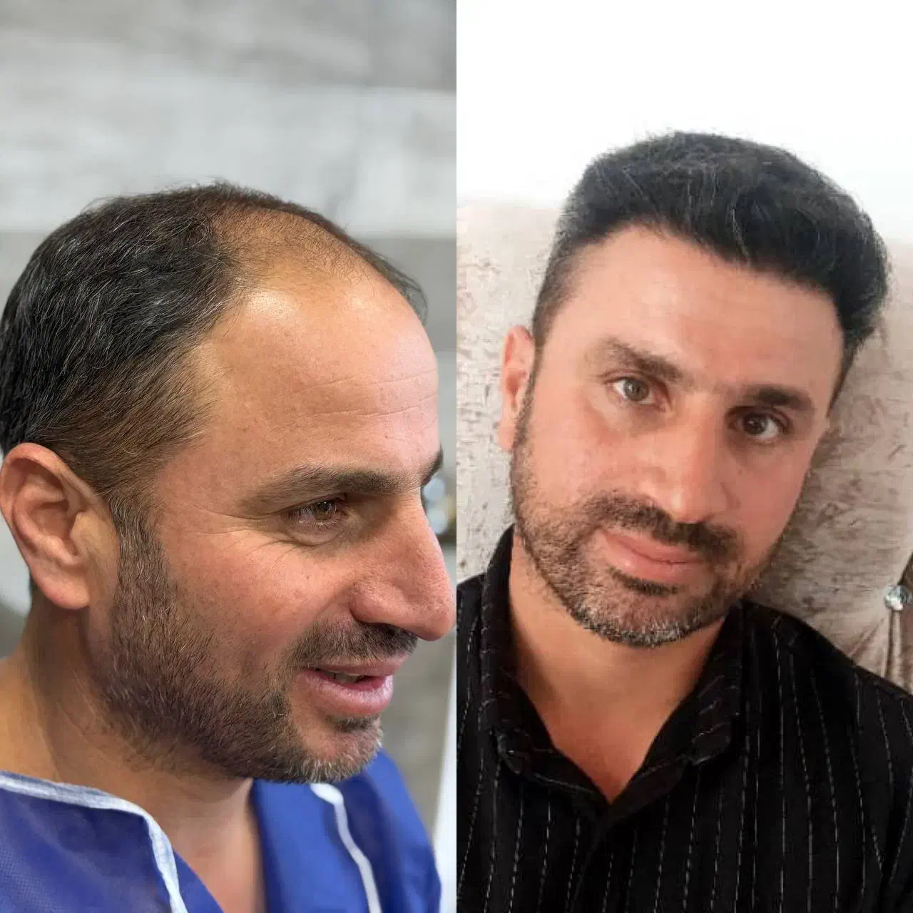 کاشت مو و ابرو.با شرایط ویژه پنچ تومن|خدمات آرایشگری و زیبایی|تبریز, |دیوار