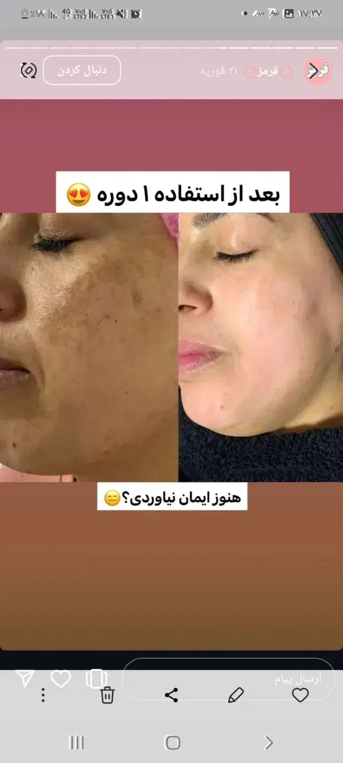 جوانسازی پوست|خدمات آرایشگری و زیبایی|گنبد کاووس, |دیوار