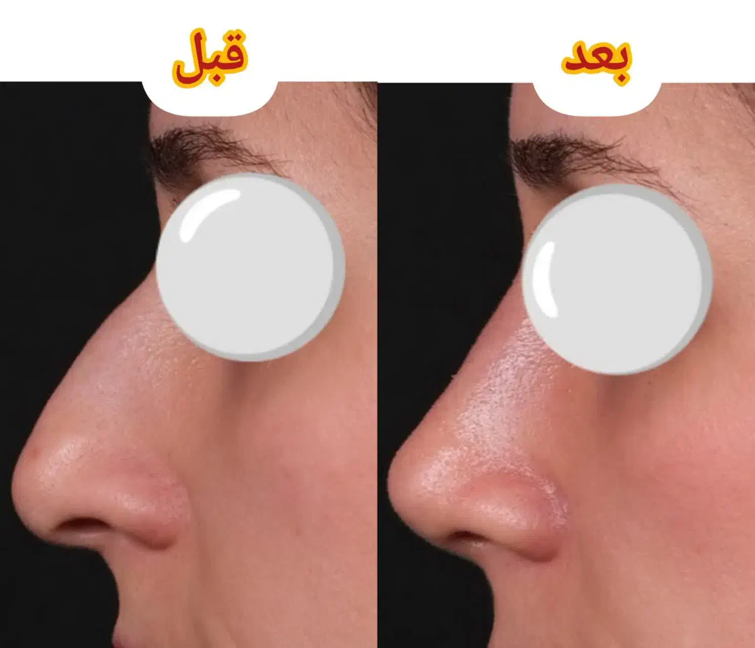 عمل زیبایی بینی|خدمات آرایشگری و زیبایی|زنجان, |دیوار