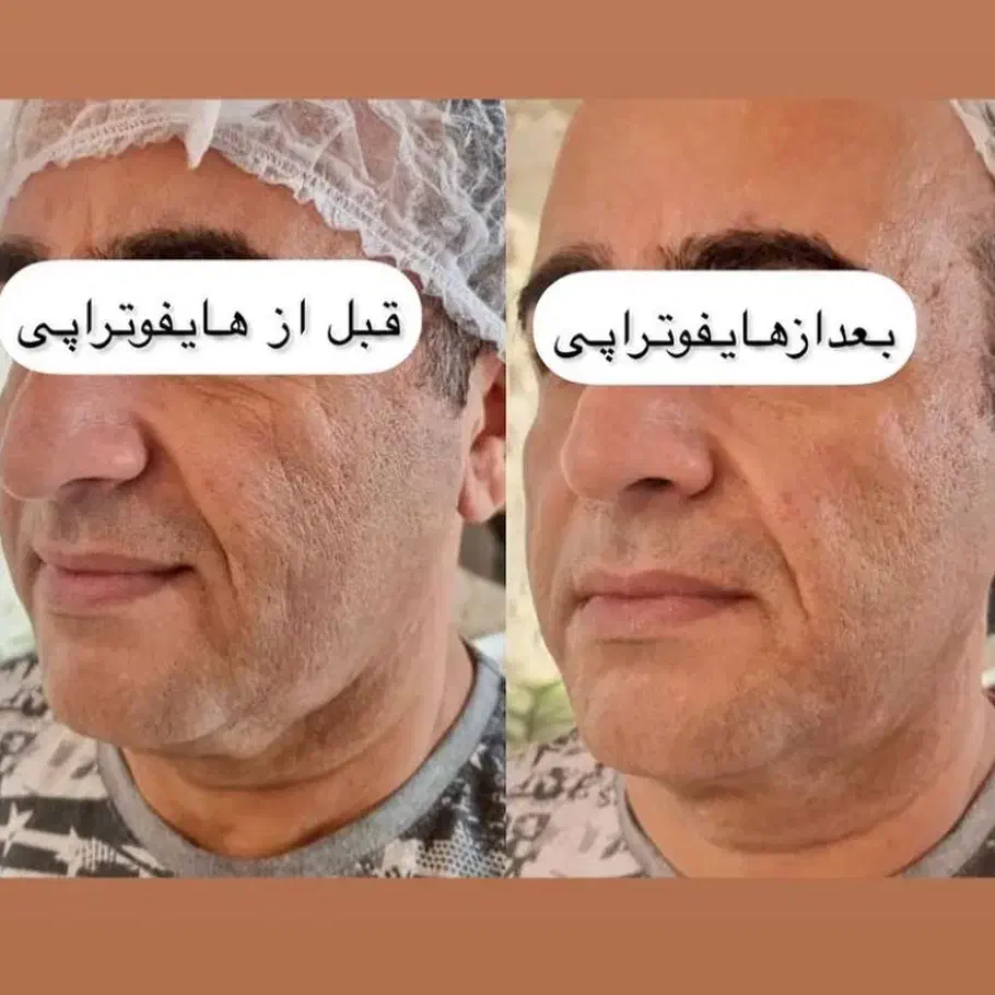 جشنواره هایفو ولیزر به مناسبت افتتاحیه ویلدا|خدمات آرایشگری و زیبایی|مشهد, آزادشهر|دیوار