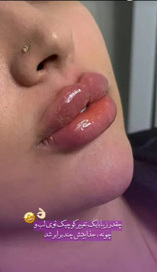 مطب پزشک.ژل وبوتاکس.لیفت بانخ.فیلربینی ژل آلت|خدمات آرایشگری و زیبایی|قم, دورشهر|دیوار