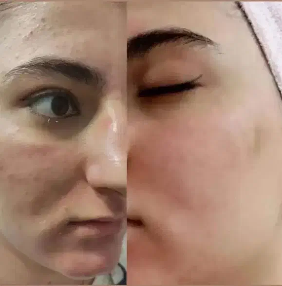 لک درمان لک صورت وبدن  وتیرگی بدن بصورت تضمینی|آرایشی، بهداشتی، درمانی|مبارکه, |دیوار
