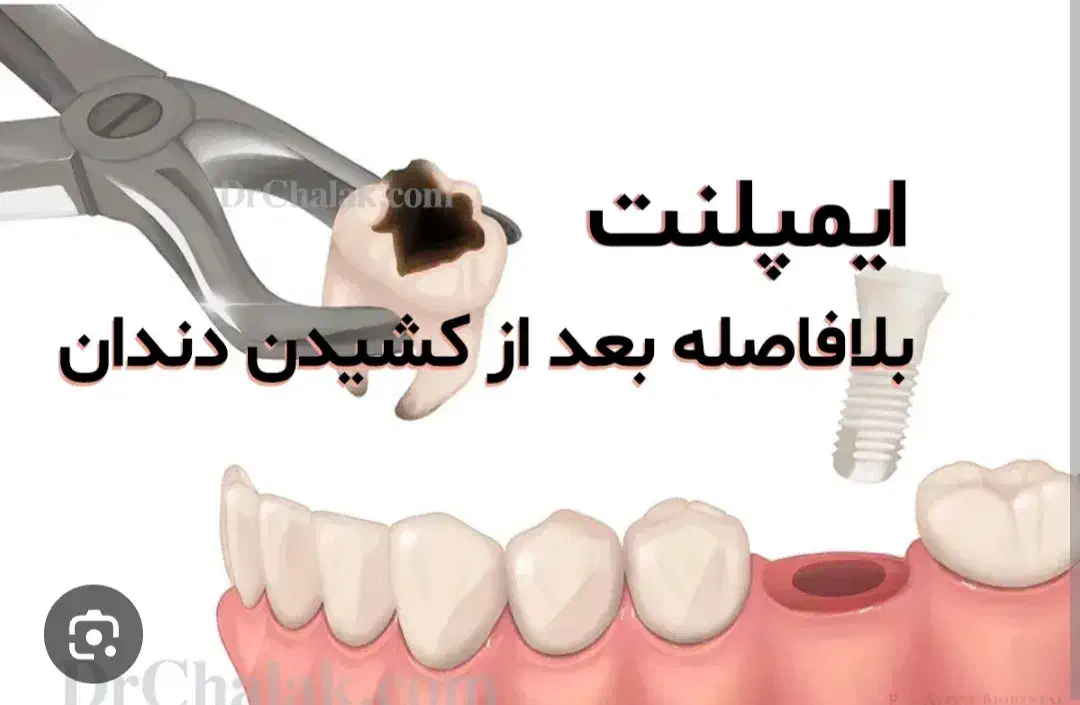 دندانپزشکی/ متخصص جراح فک ولثه /ایمپلنت 9میلیون|خدمات آرایشگری و زیبایی|مشهد, احمدآباد|دیوار