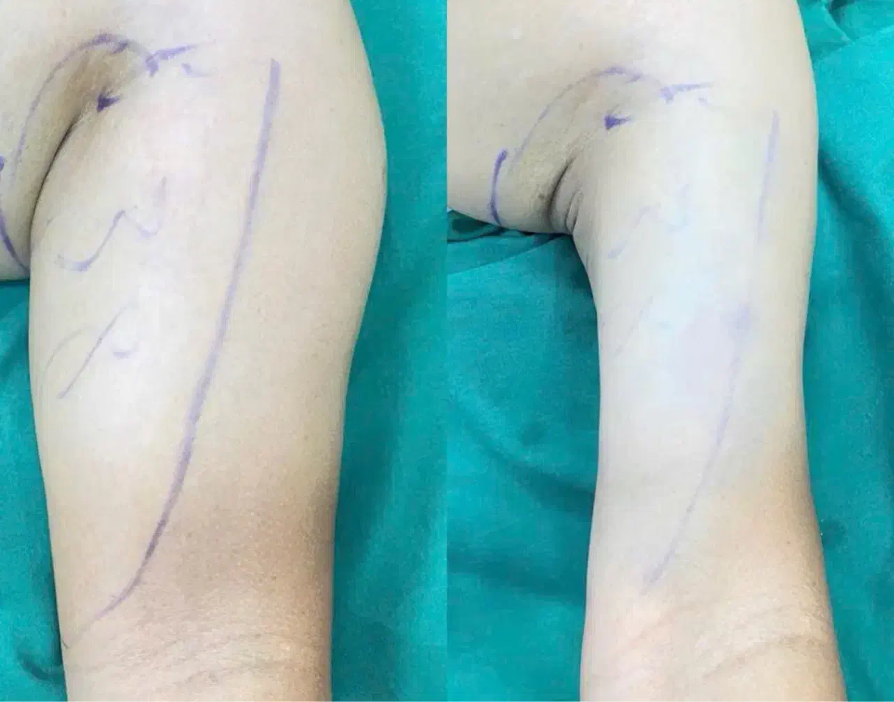 تخفیف خاص لیپوساکشن فیلر بوتاکس|خدمات آرایشگری و زیبایی|کرمانشاه, |دیوار