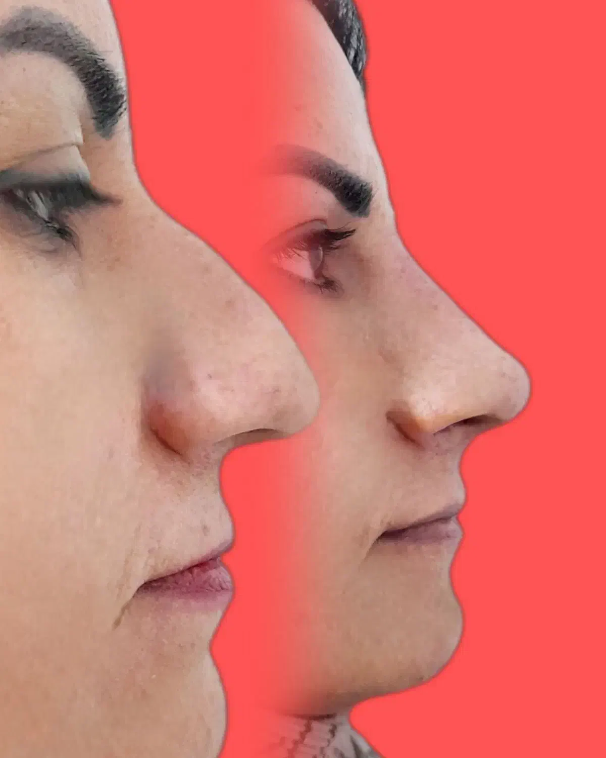 اصلاح قوز و افتادگی بینی با تزریق فیلر در مطب پزشک|خدمات آرایشگری و زیبایی|شاهینشهر, فردوسی|دیوار