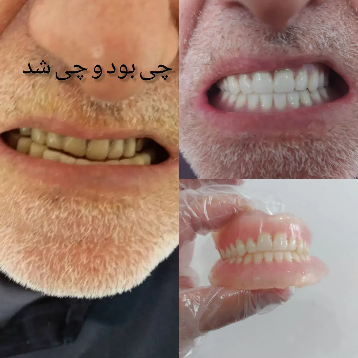 چی بود و چی شد دندان مصنوعی|فعالیت داوطلبانه|ایجرود, |دیوار