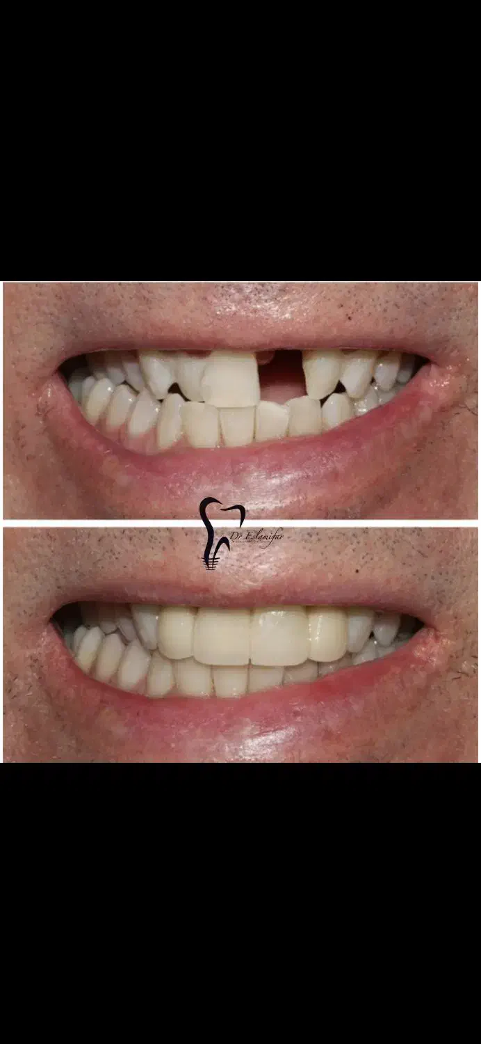 وام دندانپزشکی ایمپلنت|خدمات آرایشگری و زیبایی|رباط‌کریم, رباط‌کریم|دیوار