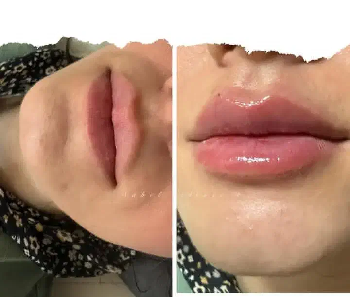 ژل بوتاکس پی آرپی لیفت مزوتراپی توسط پزشک در مطب|خدمات آرایشگری و زیبایی|اسلام‌شهر, باغ فیض|دیوار