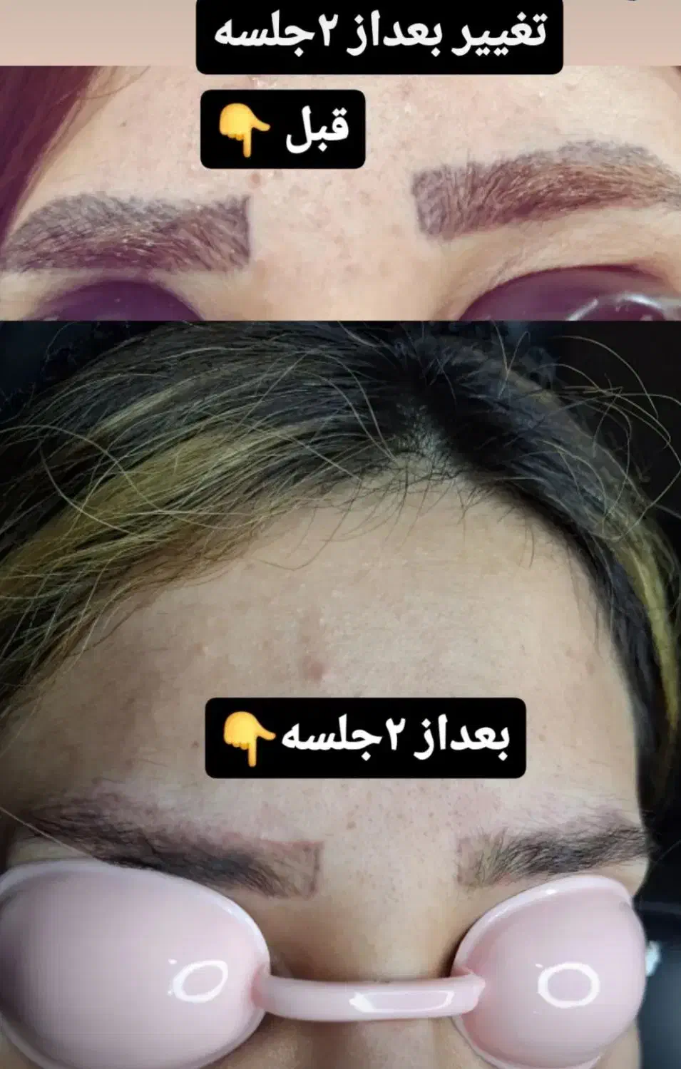 پاک کردن تاتو با دستگاه لیزر پیشرفته|خدمات آرایشگری و زیبایی|ماهدشت, |دیوار