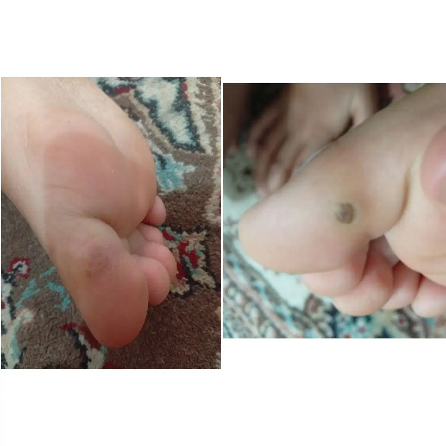 درمان ترک پا ومیخچه|آرایشی، بهداشتی، درمانی|تربت‌حیدریه, داروپخش|دیوار