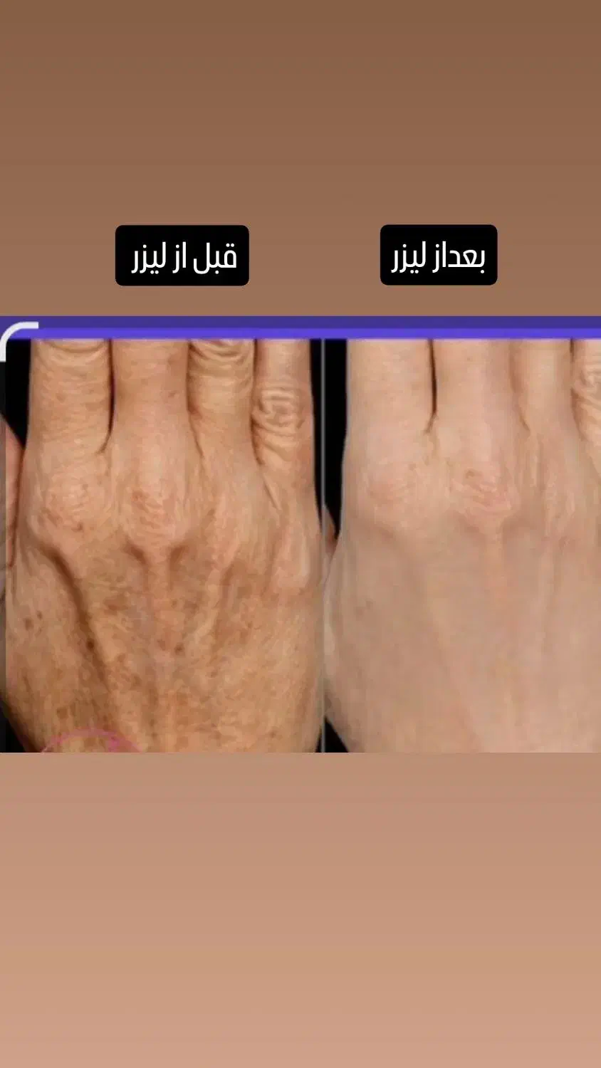 الکترولیز موی سفید وبرداشتن خال و زگیل ومیخچه|خدمات آرایشگری و زیبایی|یاسوج, |دیوار