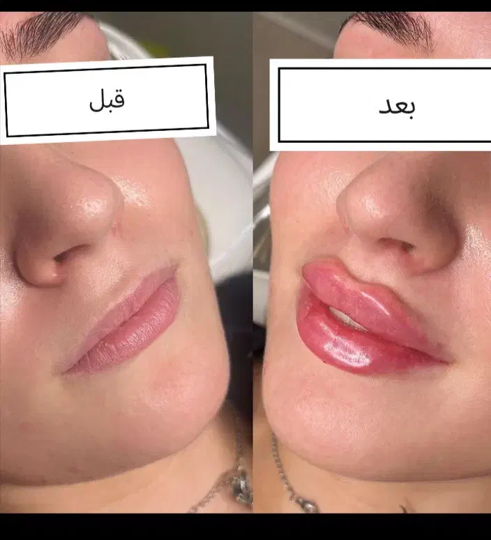 نیازمند مدل برای تزریق ژل و بوتاکس با قیمت مناسب|خدمات آرایشگری و زیبایی|برازجان, |دیوار