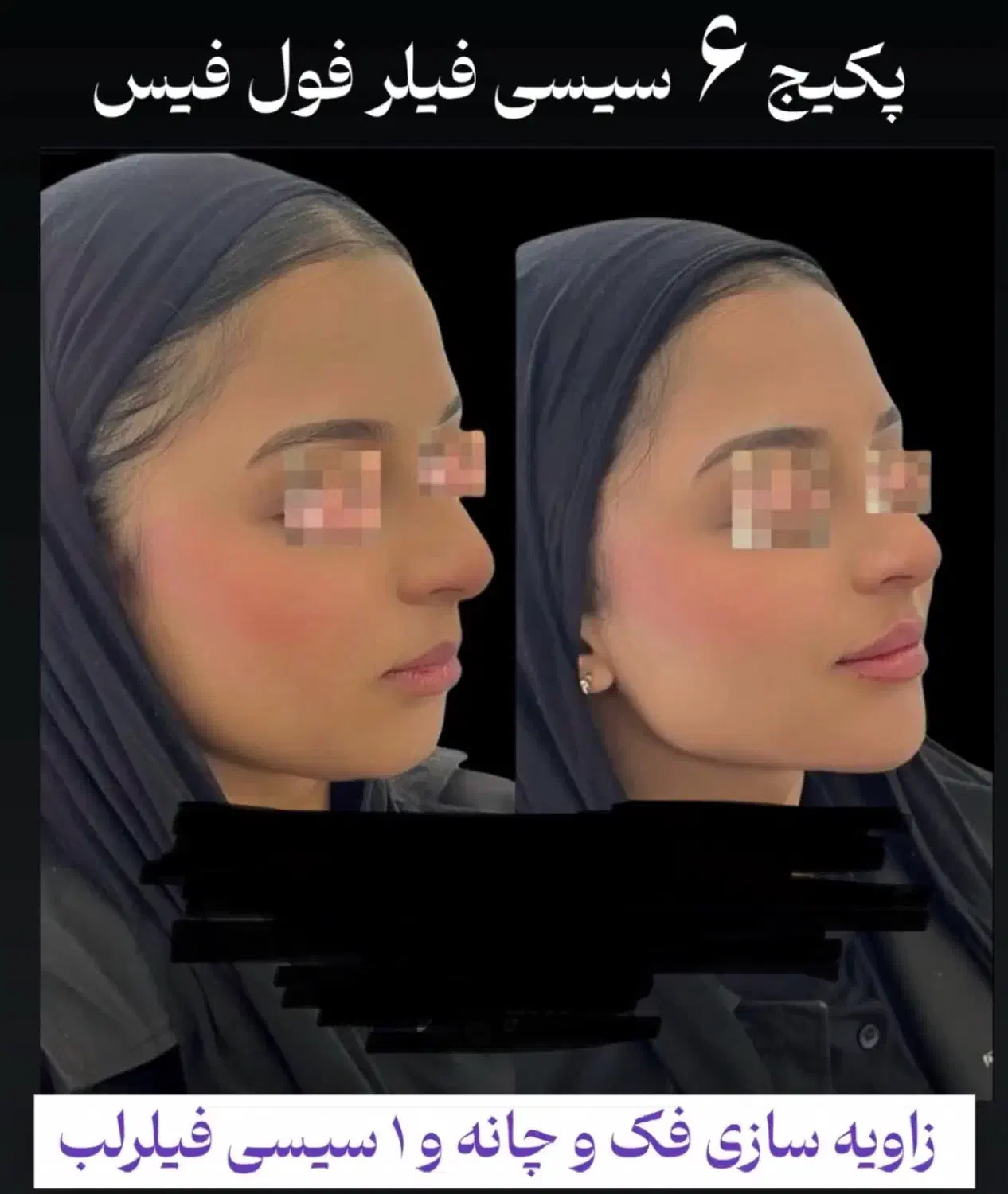 بوتاکس پیشانی و خط اخم رایگان شد توسط پزشک|خدمات آرایشگری و زیبایی|کاشان, بهشتی|دیوار