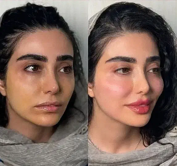 ژل لب/گونه/بوتاکس/فیلربینی/مزوپی ار پی|خدمات آرایشگری و زیبایی|مشهد, سجاد شهر|دیوار