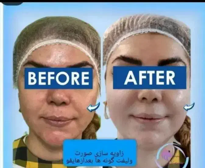 هایفوتراپی،رفع غبغب،لیزر،امبدینگ لاغری،prp|خدمات آرایشگری و زیبایی|سیرجان, |دیوار