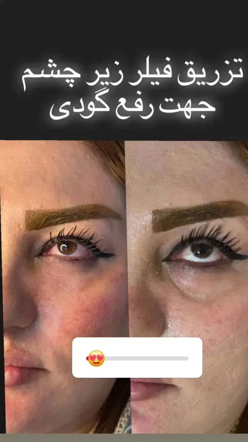 تخفیف ویژه تزریق فیلروبوتاکس باماندگاری بالا|خدمات آرایشگری و زیبایی|فلاورجان, |دیوار