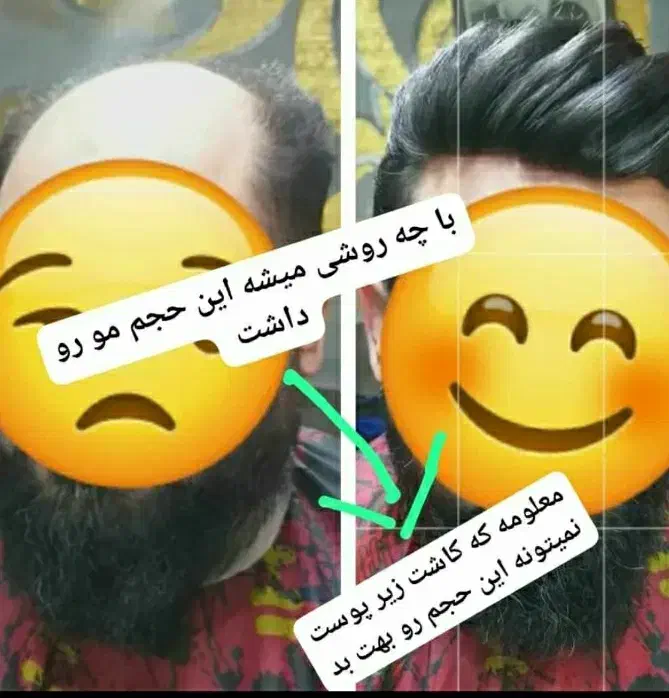 پروتز مو|آرایشی، بهداشتی، درمانی|اهواز, اهواز|دیوار